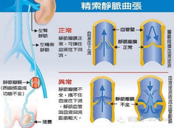 關(guān)于2021年征兵精索靜脈曲張標(biāo)準(zhǔn)的探討，2021年征兵精索靜脈曲張標(biāo)準(zhǔn)深度解析