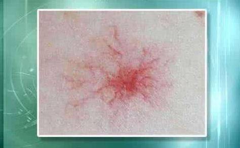 肝癌身上出現(xiàn)紅點(diǎn)圖片，癥狀解析與關(guān)注，肝癌身上紅點(diǎn)解析，癥狀、圖片及關(guān)注重點(diǎn)