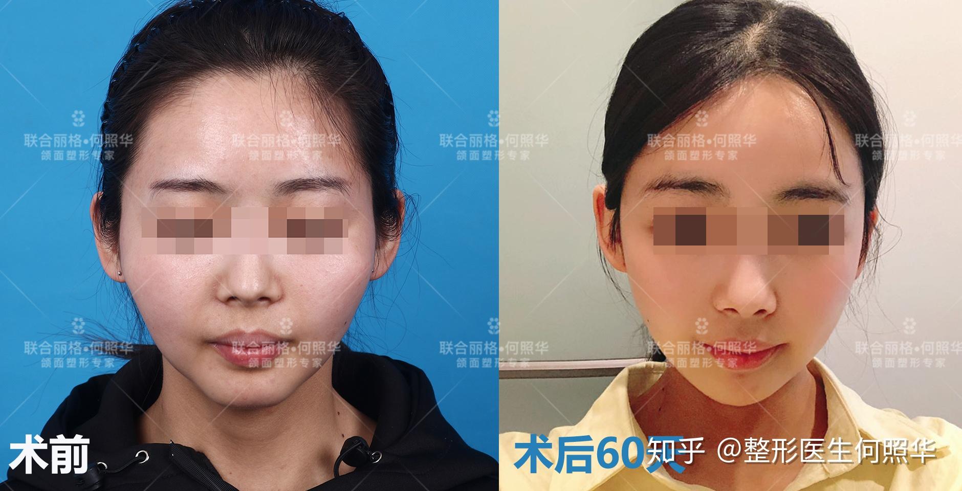 顴骨內(nèi)推3D演示，深入理解手術(shù)過(guò)程與效果，顴骨內(nèi)推手術(shù)過(guò)程與效果的3D演示理解