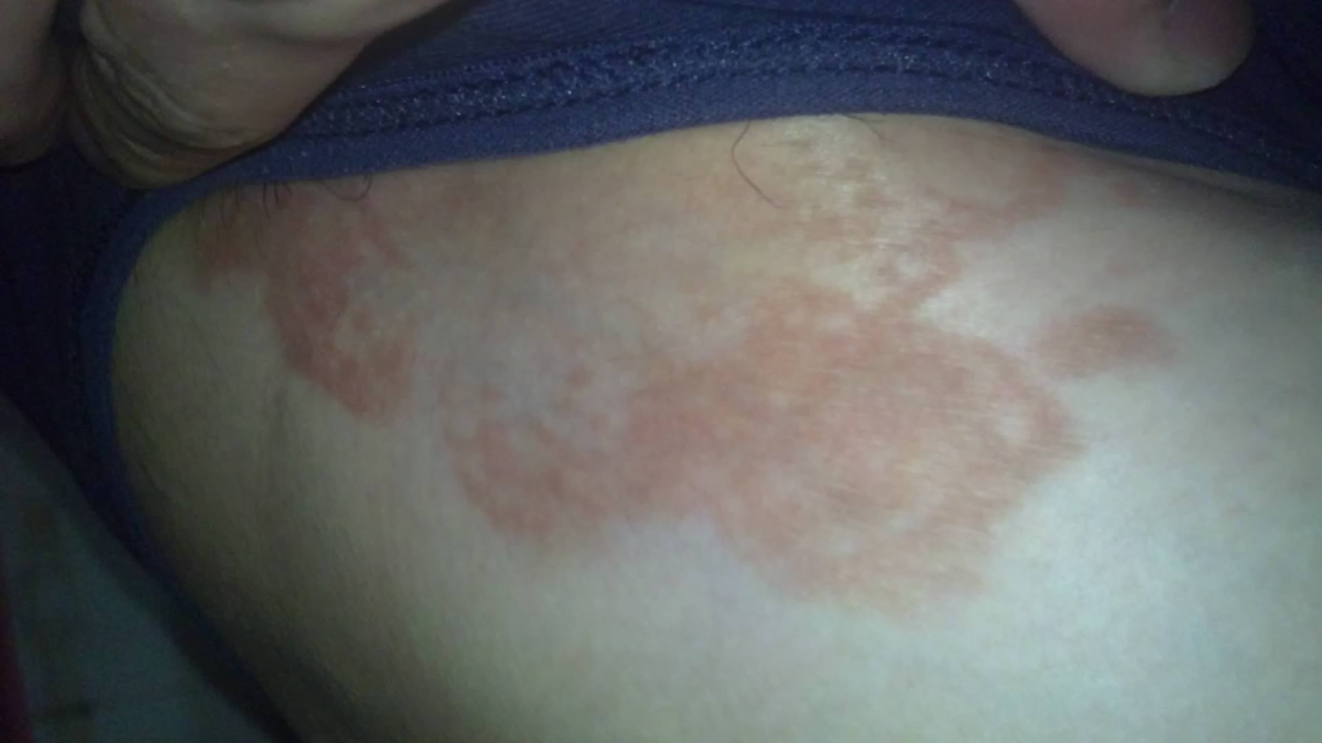 股癬最佳治療藥膏，了解并選擇最適合的藥膏，股癬最佳治療藥膏推薦，選擇最適合的藥膏治療股癬