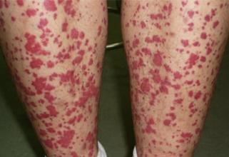 皮膚上有小紅點像血點，原因、診斷與處理方法，皮膚小紅點解析，成因、診斷及應(yīng)對方法