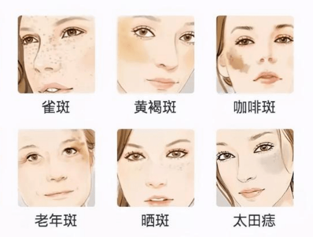 黃褐斑與曬斑的區(qū)別，深入了解兩種常見皮膚問題的差異，黃褐斑與曬斑的深入解析，兩種常見皮膚問題的差異探究