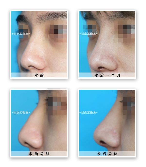 縮鼻頭，改善鼻子外觀的有效方法，縮鼻頭技巧，有效改善鼻子外觀的方法