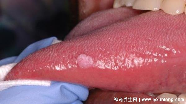 關(guān)于HPV感染舌頭初期的圖片及其相關(guān)解析，HPV感染舌頭初期癥狀圖片與解析