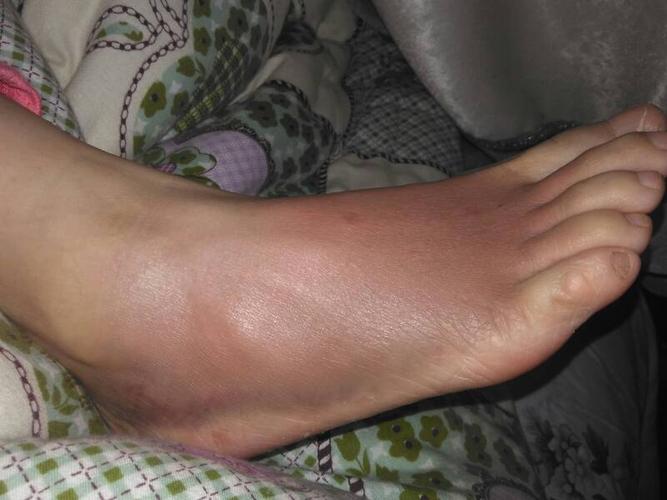 腳腫是什么原因引起的，深度解析腳部腫脹的多元因素，腳部腫脹的深度解析，多元因素引起的腳腫原因探究